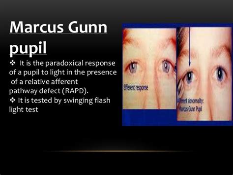 Abnormalities of pupillary reaction