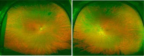 Optos photos showing (a) normal right fundus and (b) left optic nerve ...