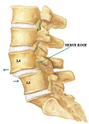 Anterolisthesis: Treatment - MedFriendly.com | health | Spondylolisthesis, Lumbar pain, Sciatica