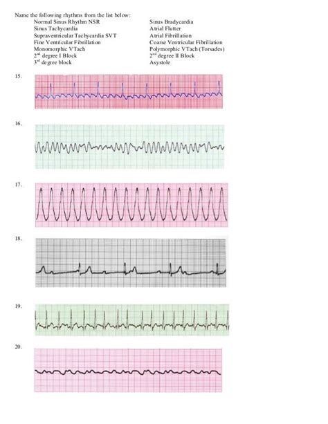 ECG ACLS Rhythms Cheat Sheet