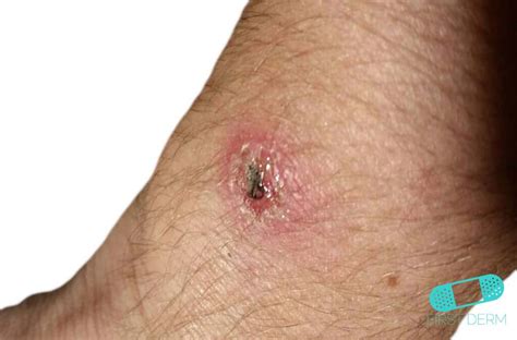 Online Dermatology - Impetigo (School Sores)