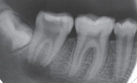 Intraoral periapical radiograph of 47 after 7 days | Open-i