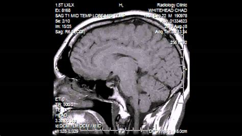 Can brain scans identify autism? | Patient Talk