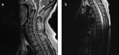 The key slices of the spinal cord MRI images of the case 1. (a ...