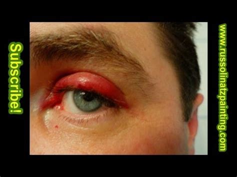 Chalazion Surgery - YouTube