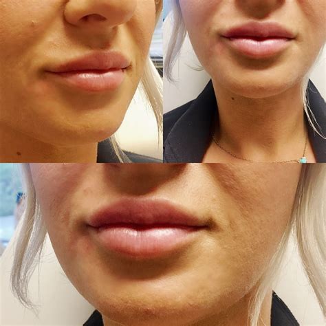 1 syringe Juvederm Ultra Plus XC to patient's lips who was desiring increased volume and ...