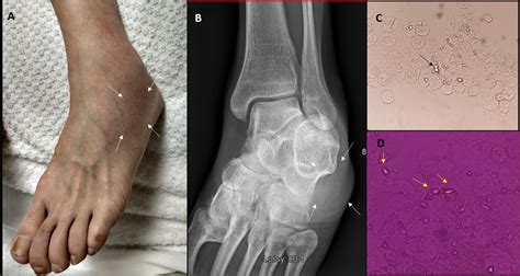 Gout Vs Pseudogout Crystals