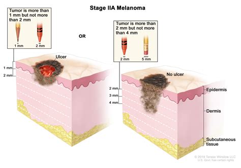 Melanoma Treatment (PDQ®)—Patient Version - National Cancer Institute