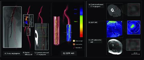 Soft superficial femoral artery (SFA) lesion. X-ray angiography and... | Download Scientific Diagram