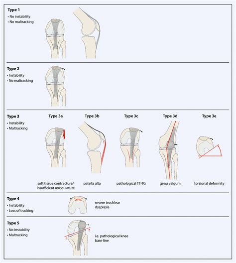 Classification of patella instability and maltracking. The grading is... | Download Scientific ...