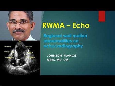 Regional wall motion abnormality (RWMA) on an echocardiogram – All ...