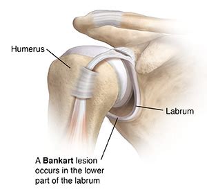 Bankart Lesion of the Shoulder Joint | Saint Luke's Health System