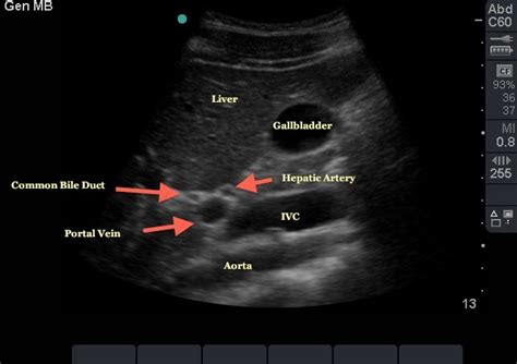 Portal Vein Anatomy Ultrasound