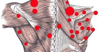 Pain Sensation: Myofascial Pain Syndrome