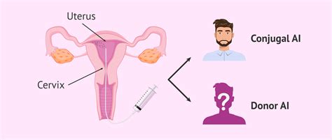 Intrauterine artificial insemination procedure