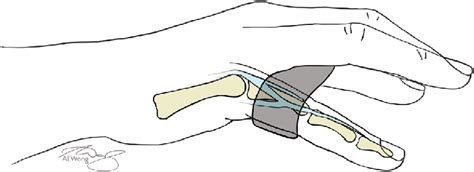 Boutonniere deformity corrected with relative motion flexion splint ...