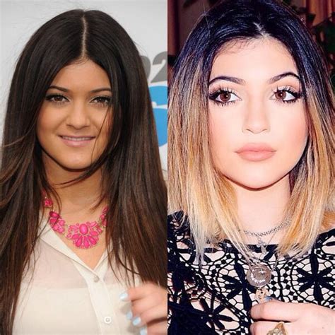 Kylie Jenner Plastic Surgery Before And After Nose Job, Lip Injections Breast Implants & Botox ...