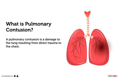 Pulmonary Contusion: Causes, Symptoms, Treatment and Cost