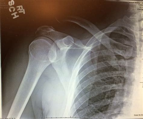 Do I have a Separated Shoulder or an AC Joint Separation? | New York, NY