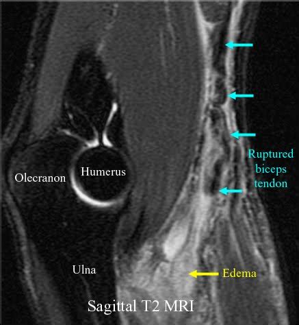 RadiologySpirit: Elbow: Biceps Tendon Rupture on MRI Scan