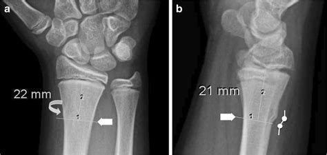 Stable distal radius buckle fracture in a 13-year-old boy. a There is... | Download Scientific ...