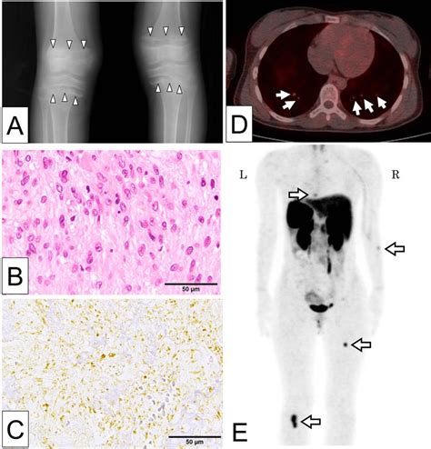 (A) Plain X-ray images of bilateral knee joints of the patient at 11 yr... | Download Scientific ...