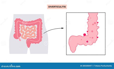 Diverticulitis and Diverticulosis Stock Vector - Illustration of pain, mucosa: 285500097