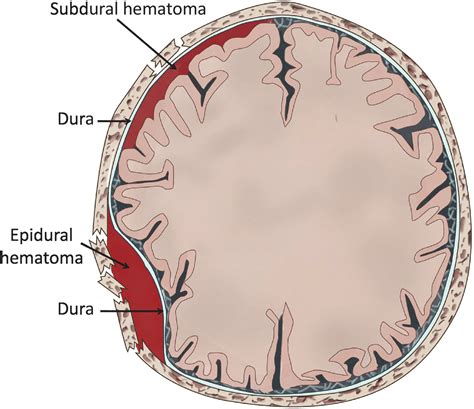 Epidural Hematoma Vs Subdural Hematoma