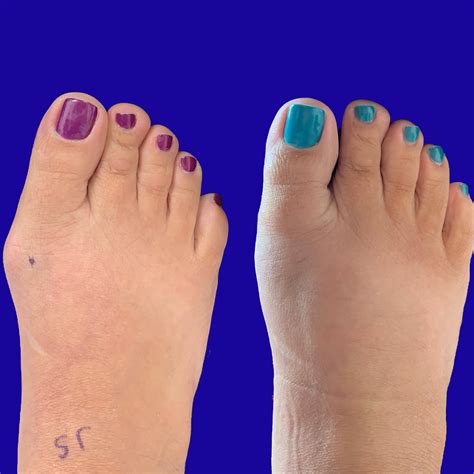 Before and After Bunion Surgery Photos | The Bunion Cure