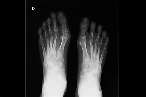 X Ray Of Foot