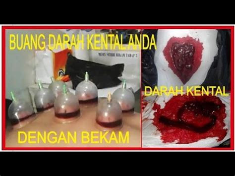 Manfaat bekam untuk membuang darah kental - YouTube