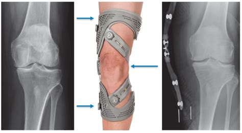 Unloader Knee Brace | Osteoarthritis Support | Orthotics Plus Melbourne