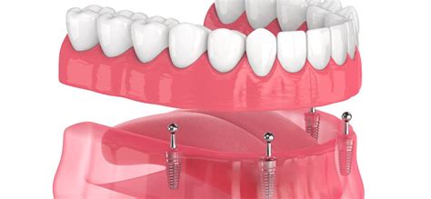 All-On-4® Dental Implants | San Ramon, CA | Pro Smile Dental Care