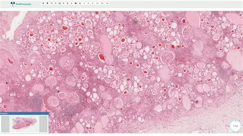 Chronic Pyelonephritis - Kidney, Histopathology - YouTube