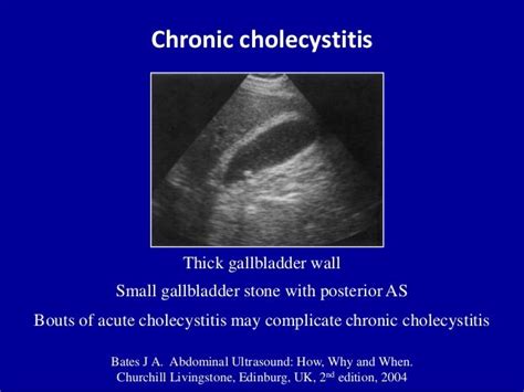 Ultrasound of acute & chronic cholecystitis