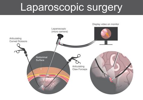 Laparoscopy – Dr. Mrs. Manisha Munemane