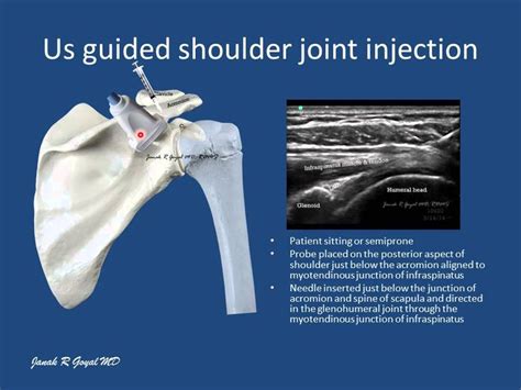 US guided shoulder joint injection- posterior GH joint approach | Joint injections, Shoulder ...