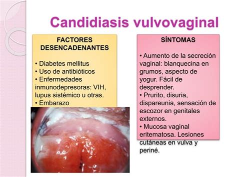 Vulvovaginitis.