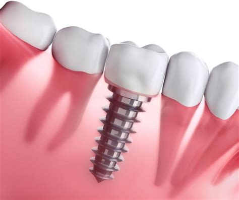 Tipos de Implantes Dentales | Clínica Dental Dra. Ana Belén Martínez