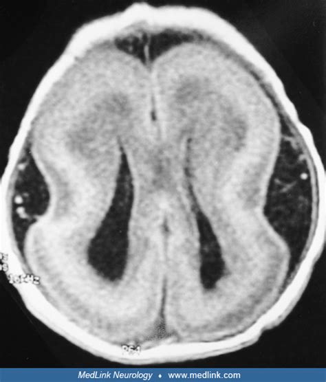 Lissencephaly Syndrome