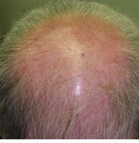Figure 1 from Resistant scalp folliculitis secondary to Demodex infestation. | Semantic Scholar