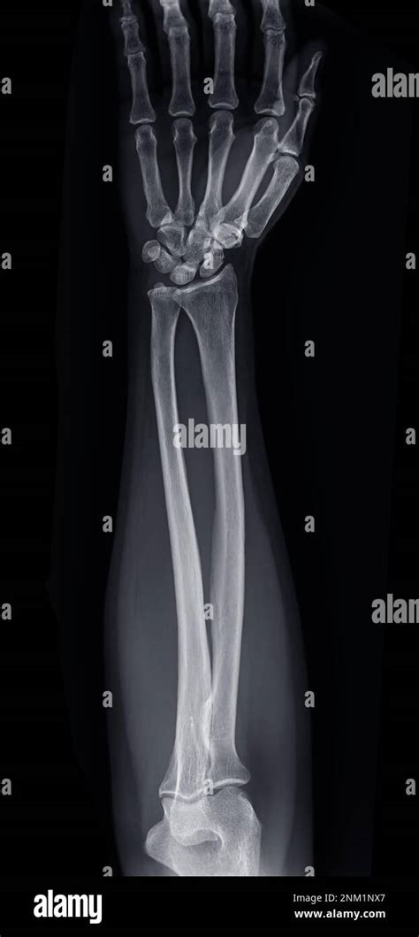 X-ray image of forearm bone Stock Photo - Alamy