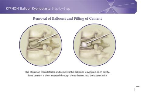 Balloon Kyphoplasty Step By Step Procedure Guide