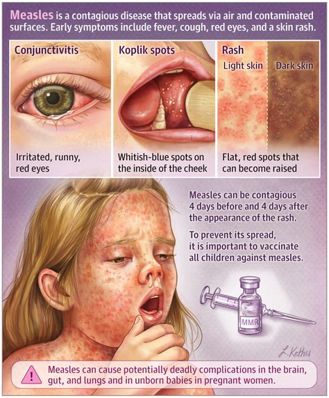 Measles | Infectious Diseases | JAMA Dermatology | JAMA Network