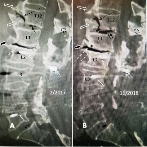 Cureus | An Unusual Vertical T12 Fracture Extending into the T12-L1 Disc in a Patient with ...