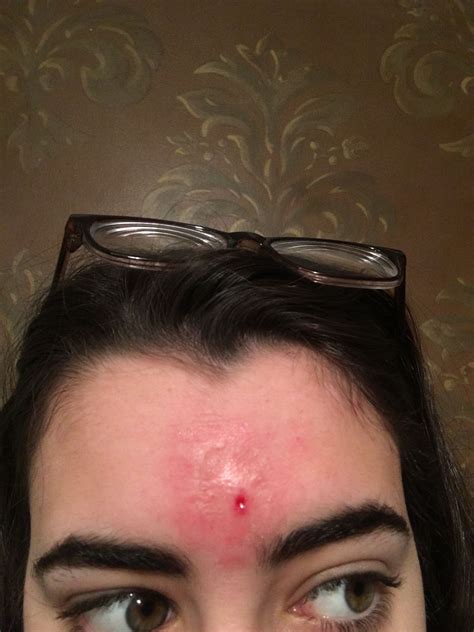 Whats going on with my forehead? - General acne discussion - Acne.org