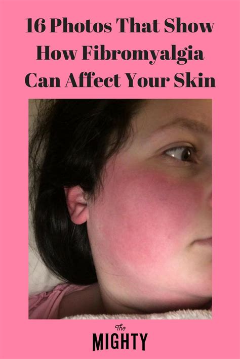 16 Photos That Show How Fibromyalgia Can Affect Your Skin ...