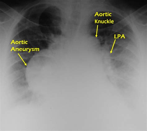 X-ray chest PA view in aortic aneurysm – All About Cardiovascular System and Disorders