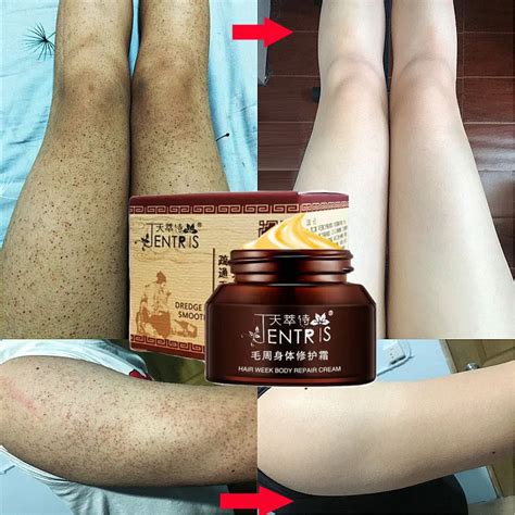 50g Curing Keratosis Pilaris Chicken Follicle Skin Repair Cream Body Dark Spot Remove Brighten ...