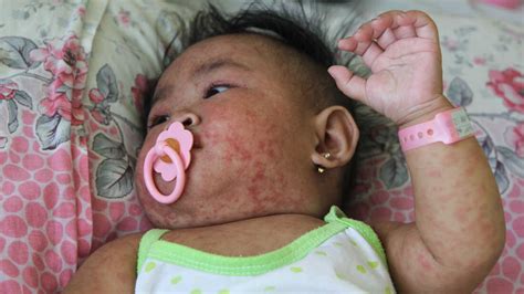 How The Philippines Is Fighting One Of The World's Worst Measles ...